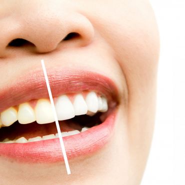 Descubre el revolucionario tratamiento de blanqueamiento dental láser en Clínica Dental Odens